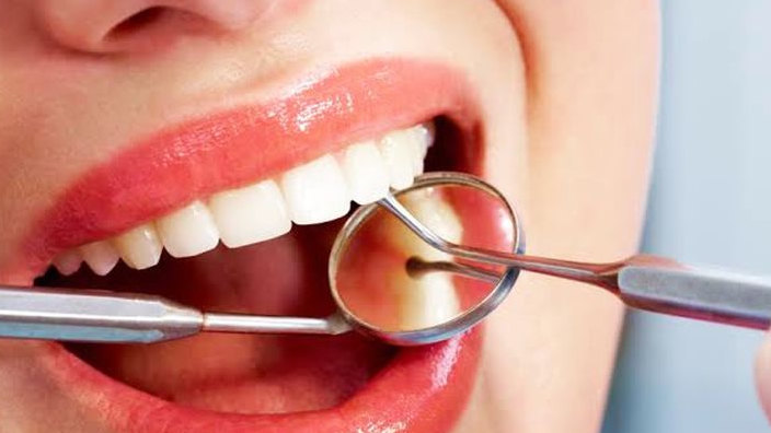 Apakah Bleaching Selalu Menjadi Solusi Memutihkan Gigi? Kenali Kelebihan dan Kekurangannya